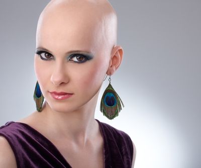alopecia areata